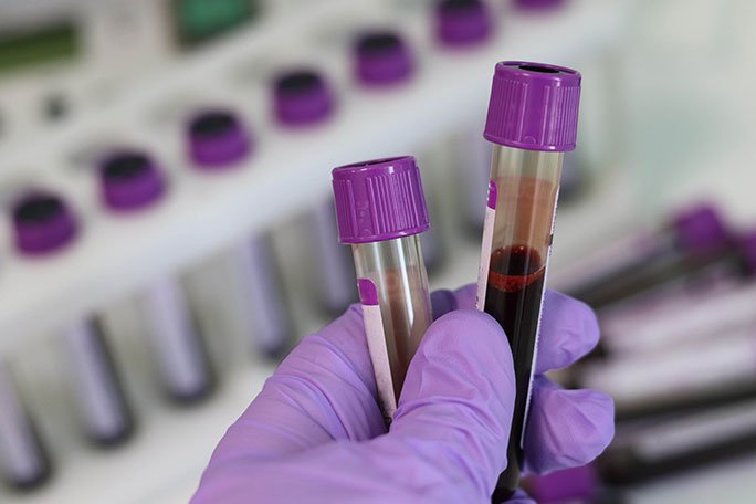 Blood Test:MRT Lab Draw
